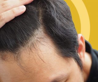 Receding Hair Growth