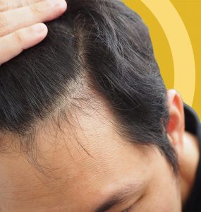 Receding Hair Growth